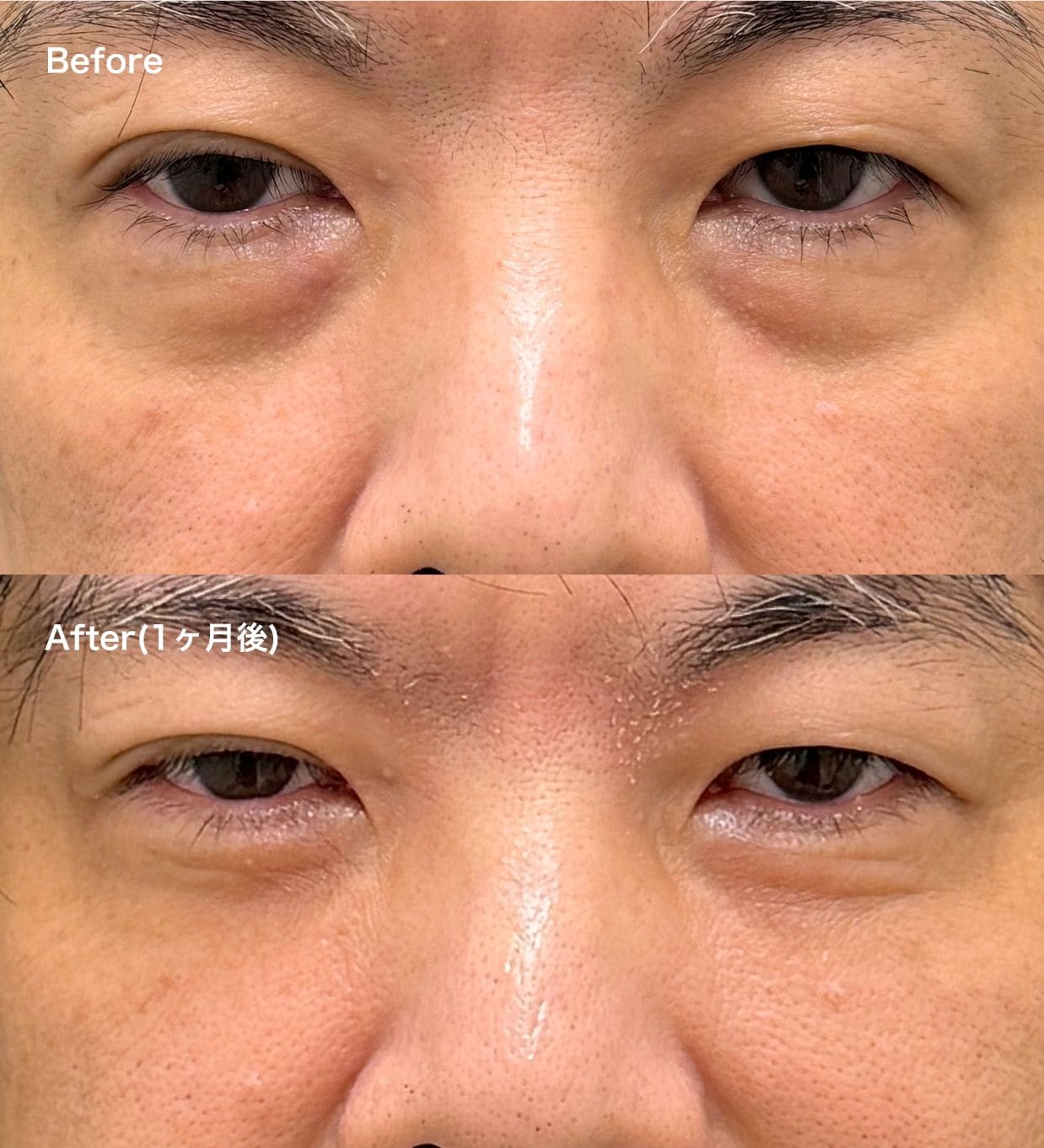 50代：大きな膨らみ（目袋）を整え、年相応の渋さと凛々しさを