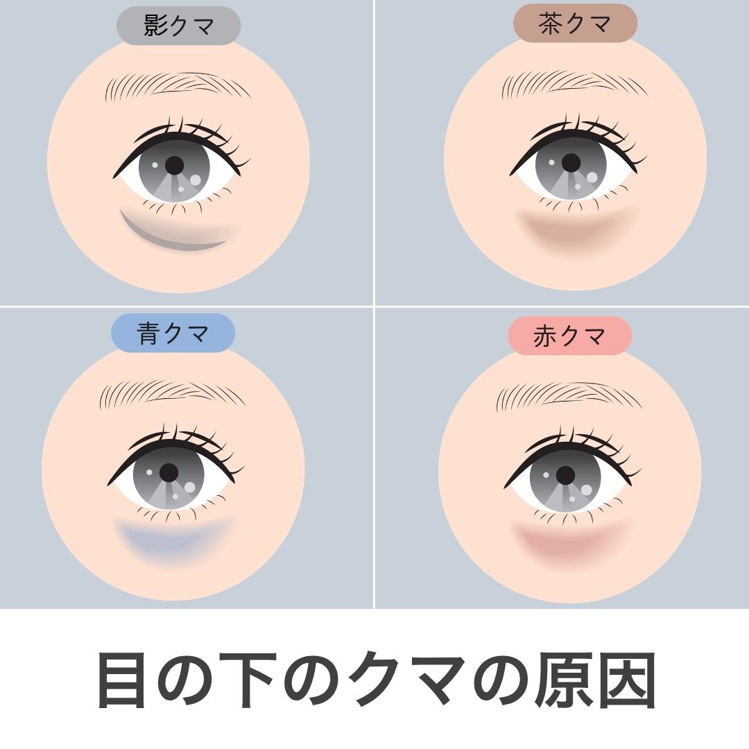 【医師監修】目の下のクマの原因とは?3つの種類(黒・青・茶)の見分け方とセルフチェック