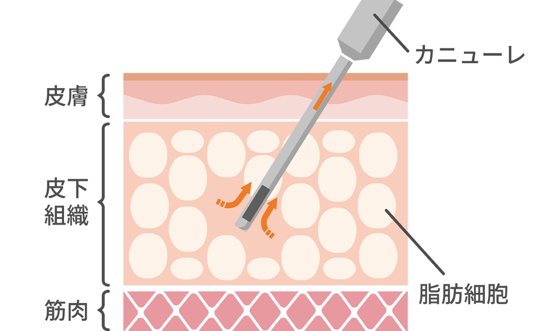 そもそも脂肪吸引ってなに？