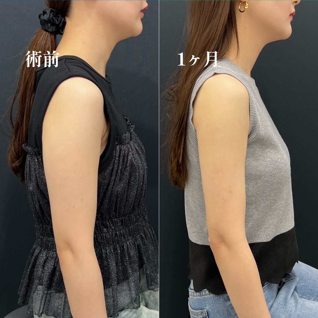 中部名古屋で二の腕脂肪吸引するなら【名医のこだわり】金山院 湘南 