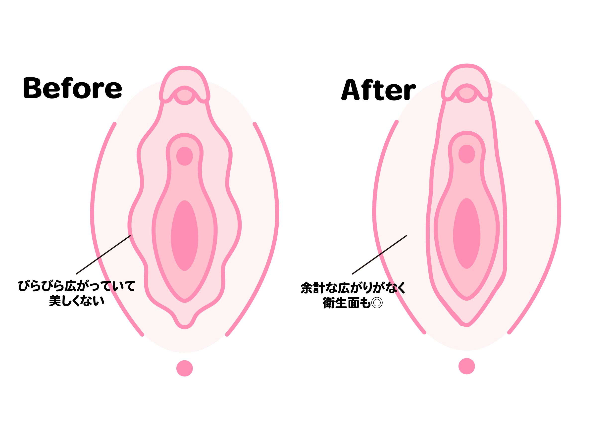 小陰唇縮小術のイメージイラスト