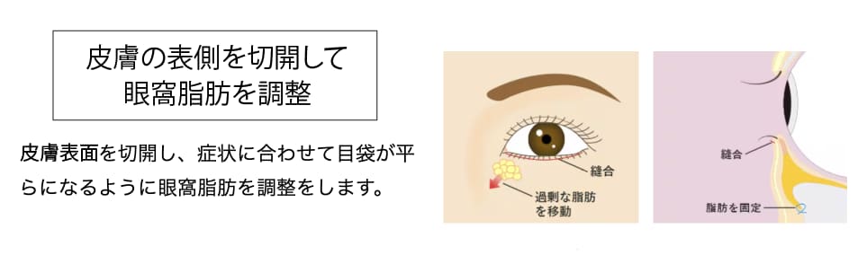 再発防止と皮膚のたるみも改善ができる「切開ハムラ」