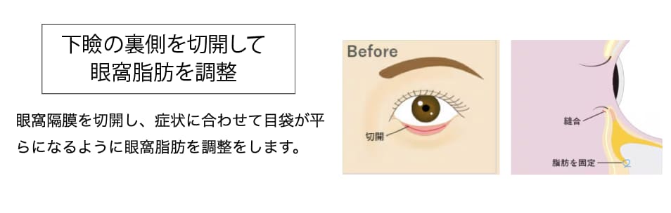 再発防止、そして表にも傷のつかない裏ハムラ