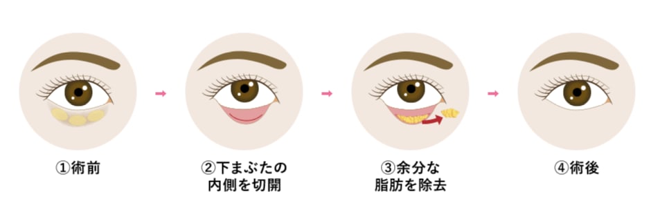 表に傷のつかない「目の下のクマ取り」