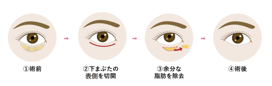 たるんだ皮膚も改善できる「アイバックリムーブ」