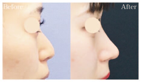 金沢院での鼻整形ピックアップ症例