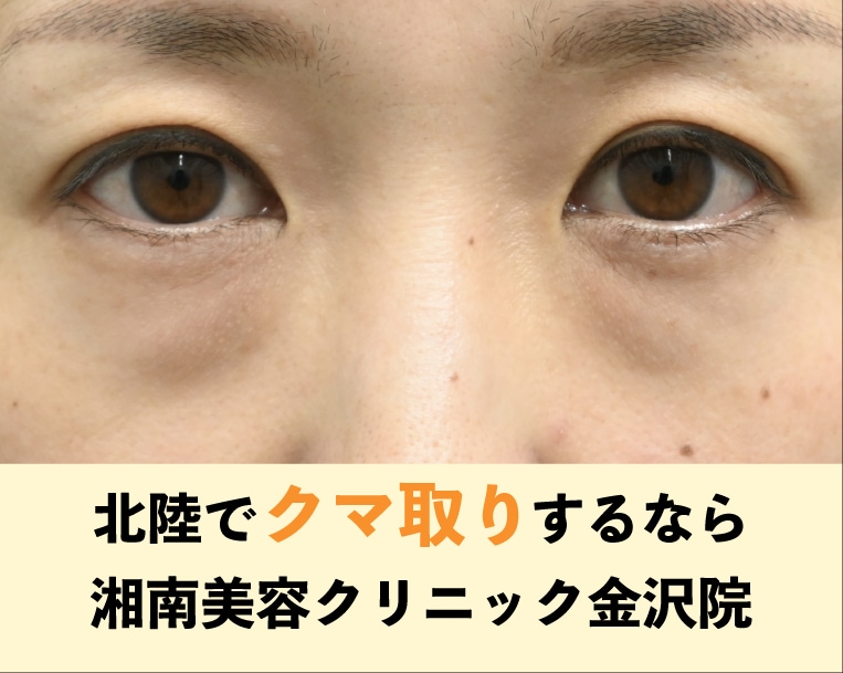 北陸・金沢でクマ取りするなら湘南美容クリニック金沢院【クマ取り】【目の下のたるみ】