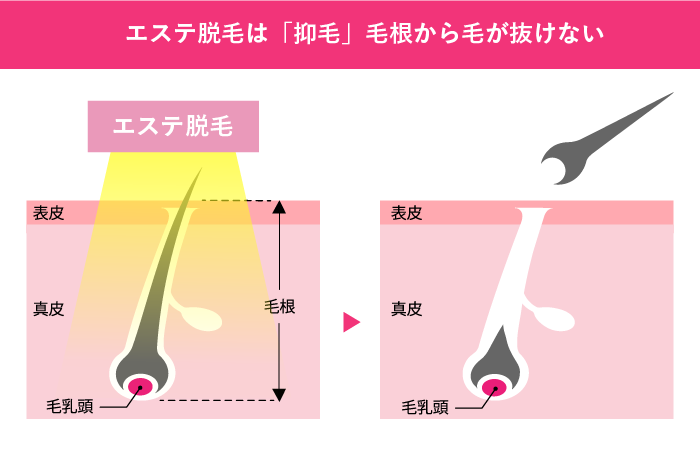 エステ脱毛のメリット・デメリット