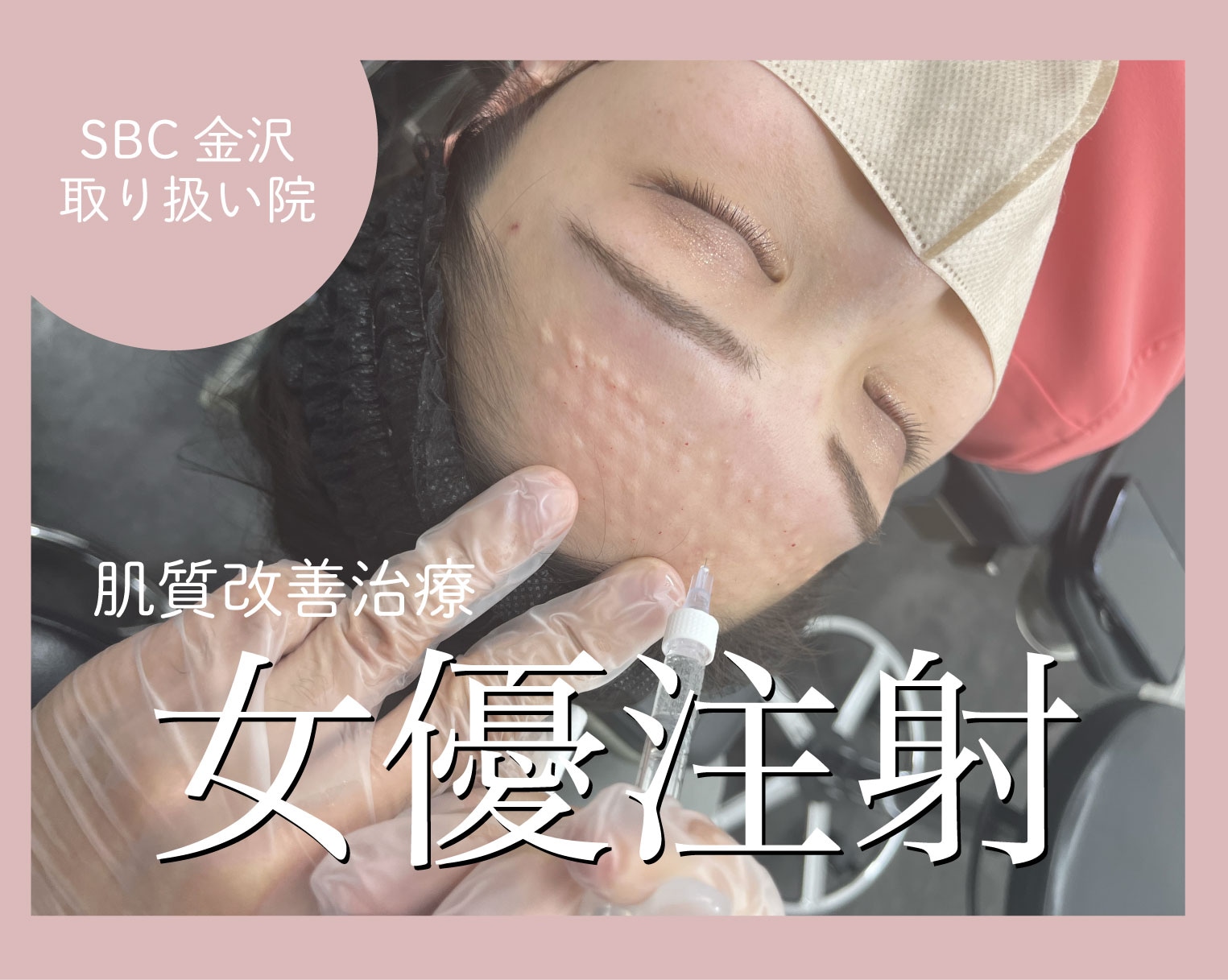 【SBC金沢取り扱い院】肌質改善するなら女優注射！陶器肌を目指す美容医療はコレ！