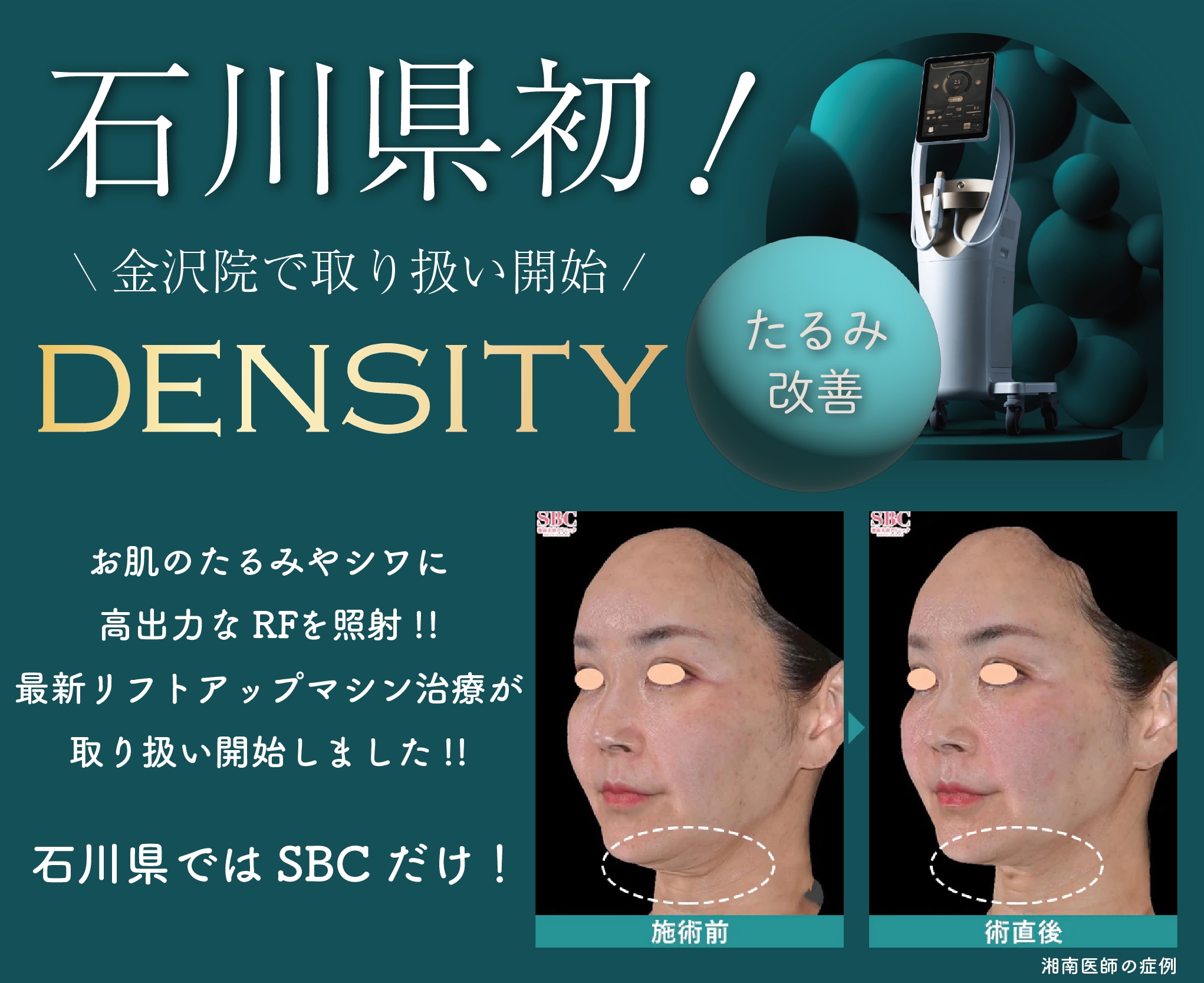 石川県初！最新リフトアップ治療「デンシティ」でたるみ改善！