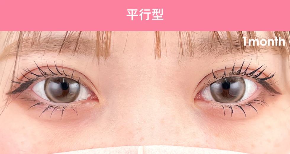 {クイックコスメティークダブル} {10代}  {女性} の術後の症例写真