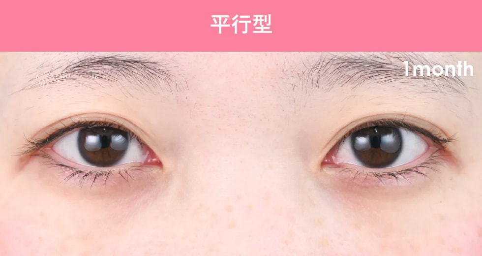 {クイックコスメティークダブル} {10代}  {女性}の術前の症例写真