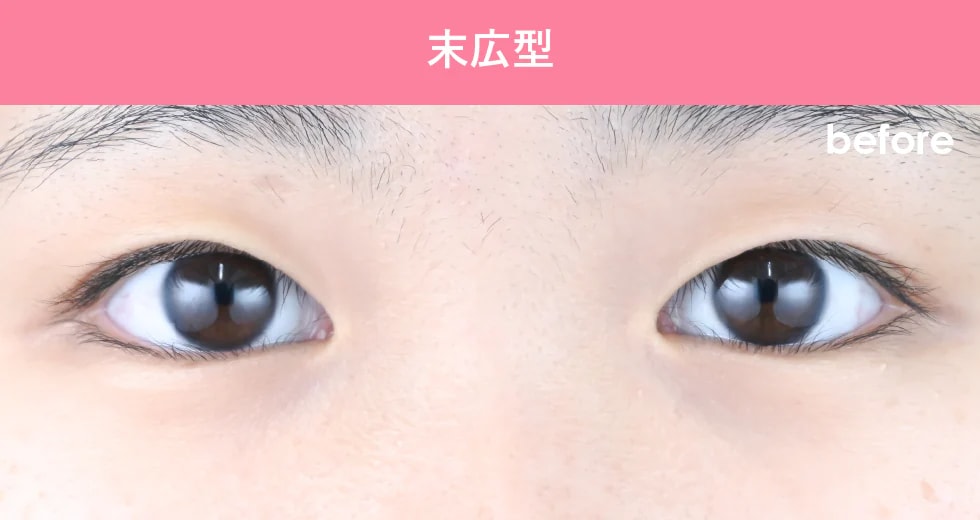 {クイックコスメティークダブル} {10代}  {女性}の術前の症例写真