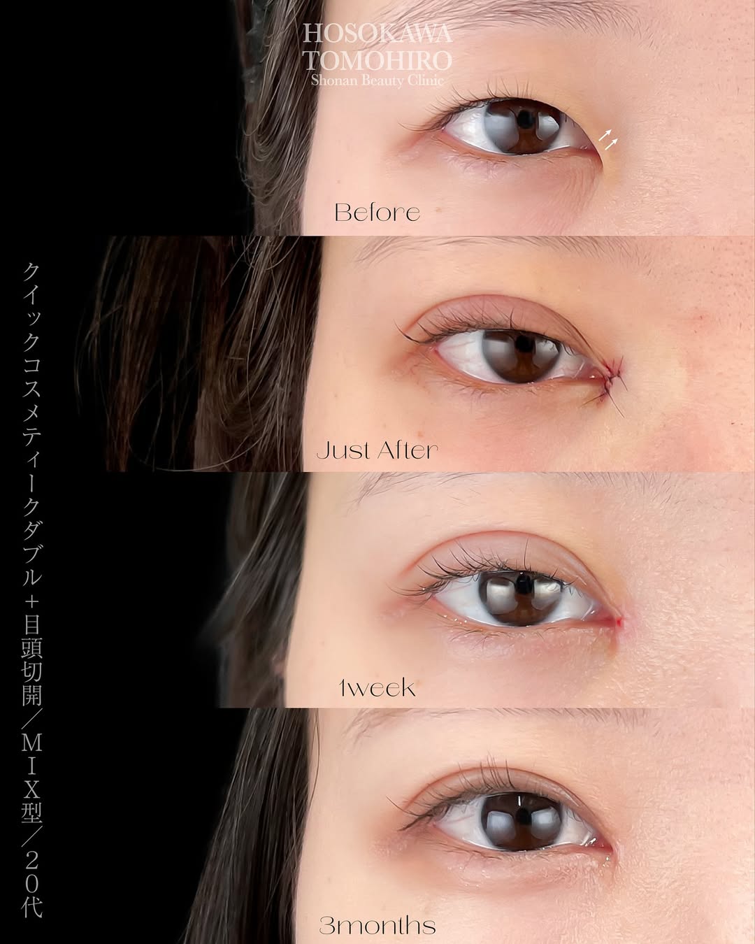 蒙古襞があり、MIX二重希望のお客様