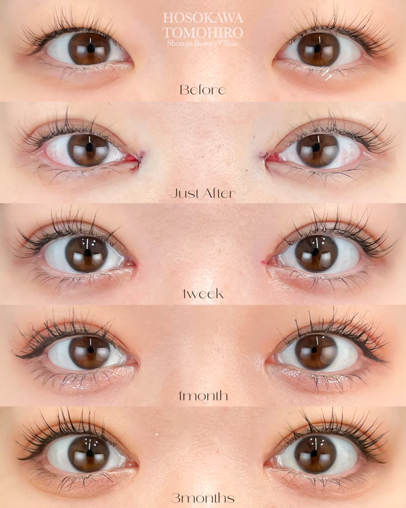 幅の広い並行二重を希望のお客様