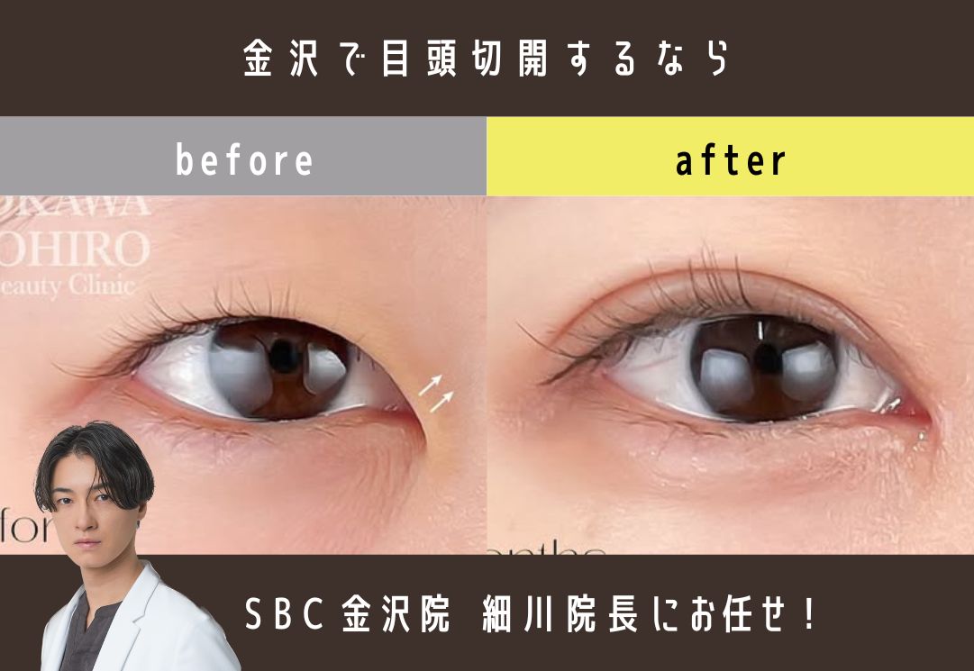 金沢で憧れの平行二重に！SBC金沢院の「目頭切開×二重整形」で離れ目・蒙古ひだを解消
