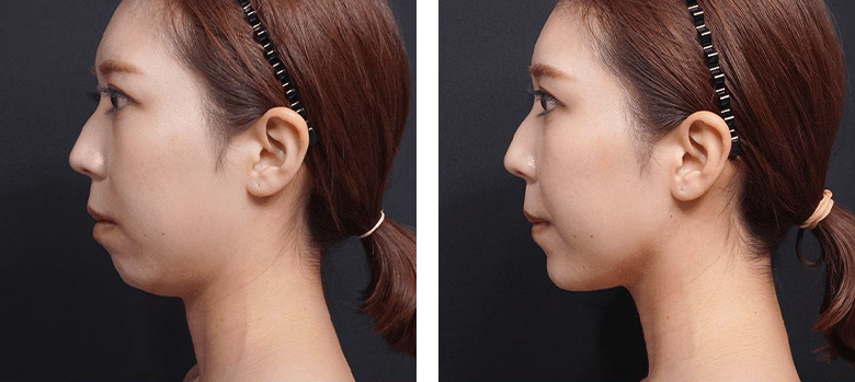 顎下すっきリフト4本