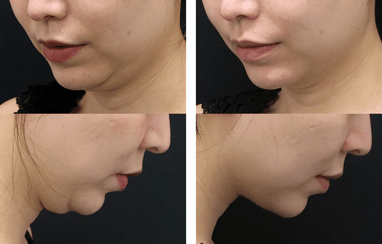 顎下すっきリフト4本