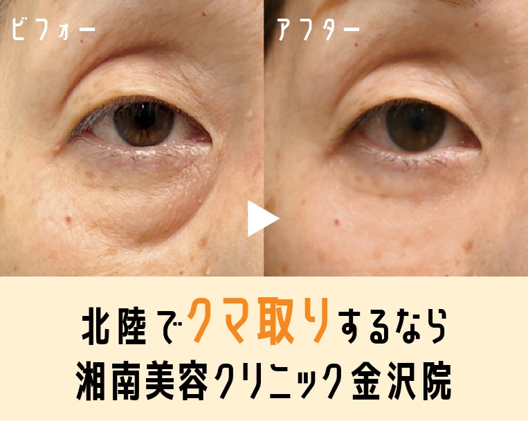 【金沢】クマ取り・ハムラ法なら金沢院長 細川にお任せ｜症例数・満足度で選ぶならSBC金沢院