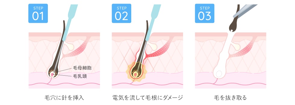 ニードル脱毛って？