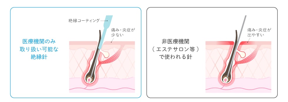火傷を防ぐ「絶縁針（ぜつえんしん）」を使用