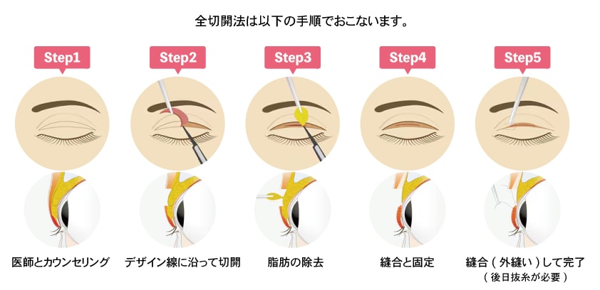 一生モノのラインを作る「切開法」との違いは？