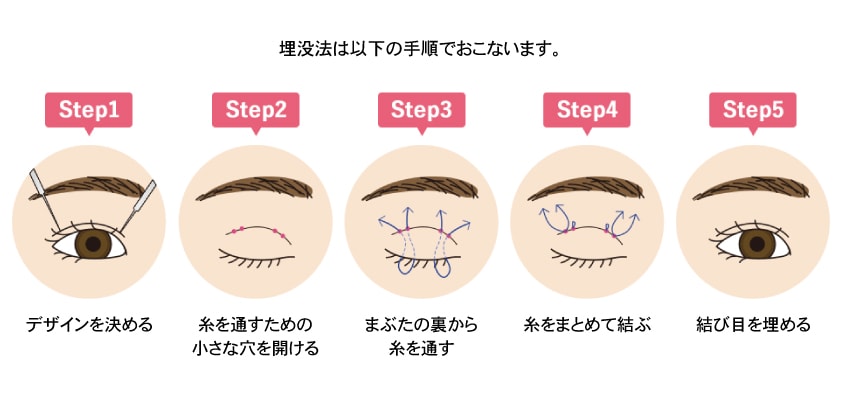 切らずに理想の二重を叶える「埋没法」とは？