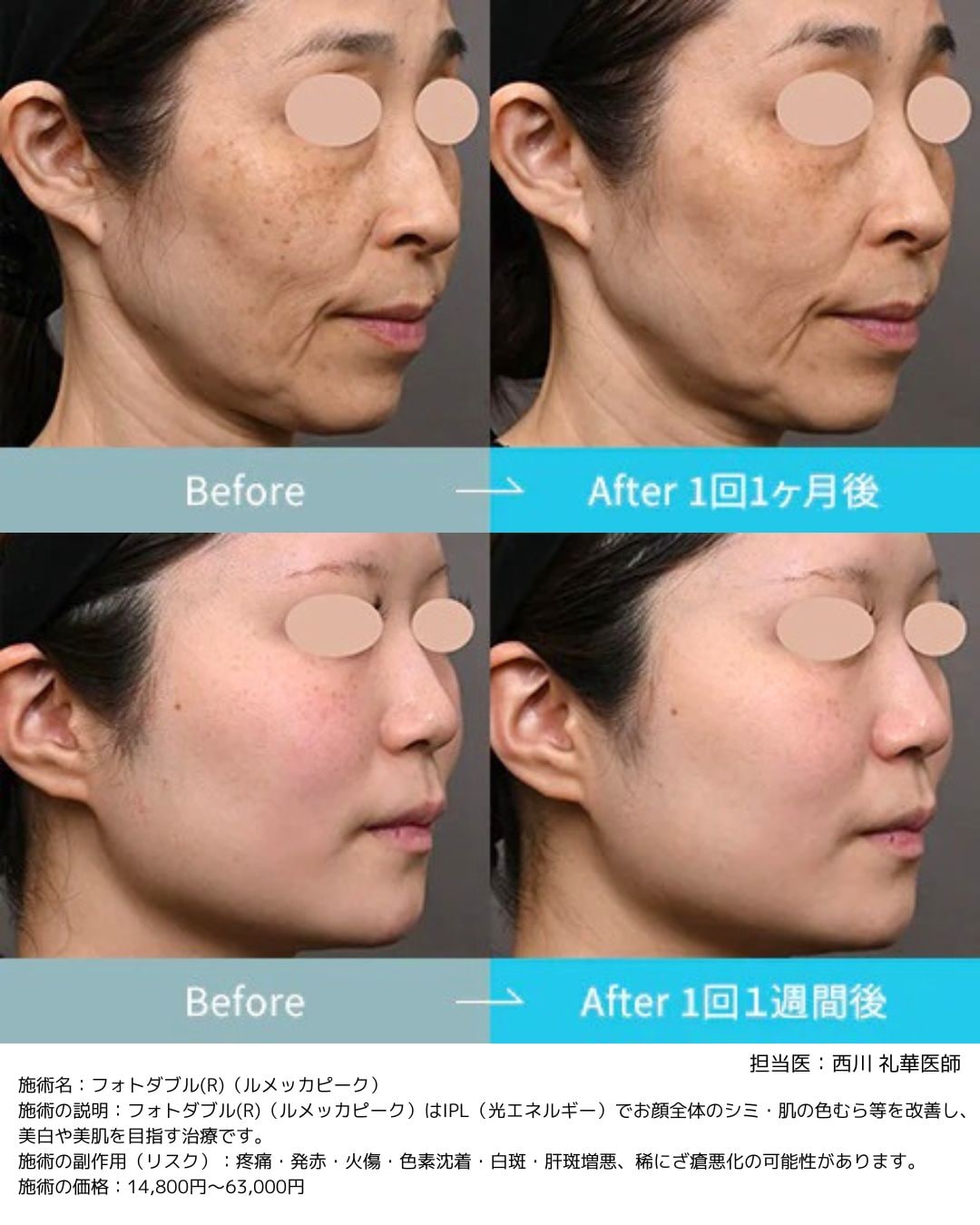 金沢でルメッカピークなら｜安さと効果で選ばれる湘南美容クリニック