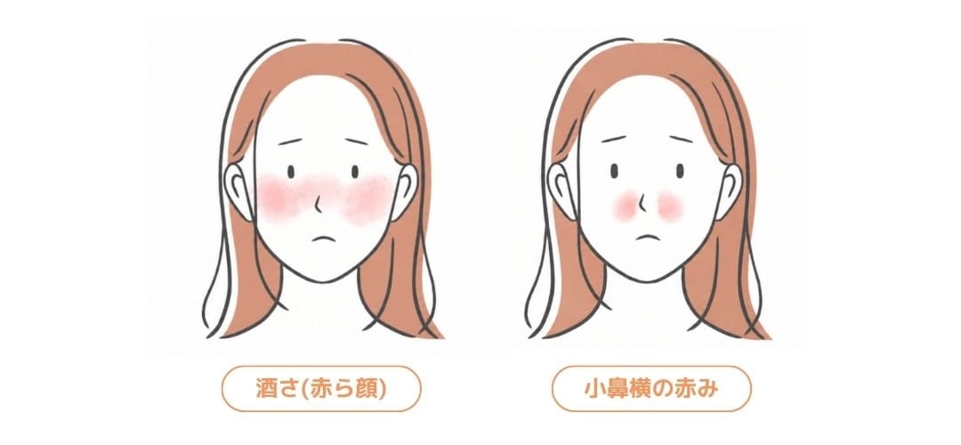 赤ら顔・酒さ・毛細血管拡張症の改善