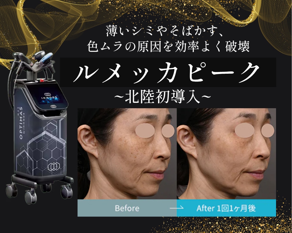 【金沢駅直結】ルメッカピーク導入！シミ・赤ら顔治療なら湘南美容クリニック金沢院