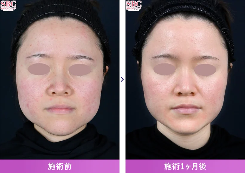 エラ張り解消！フェイスラインがスッキリ✨<br />
