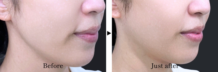 肌のもたつきを引き締め、スッキリとした輪郭へ 