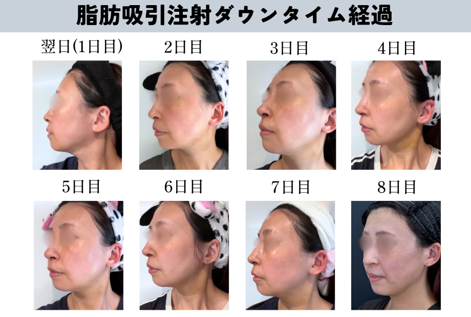 顔の脂肪吸引のダウンタイム