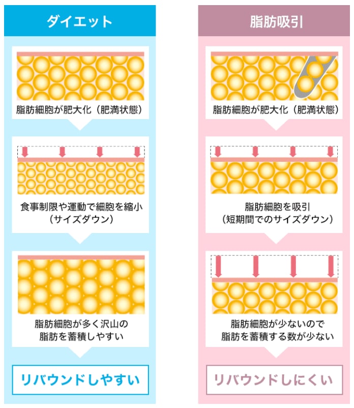 顔の脂肪吸引とは