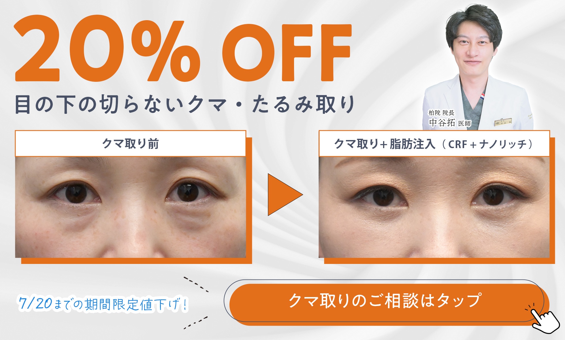 【期間限定】クマ取り治療が今お得に受けられる！