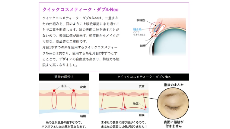 SBCで挙筋法を行うメリット