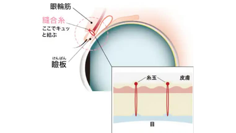 瞼板法と挙筋法