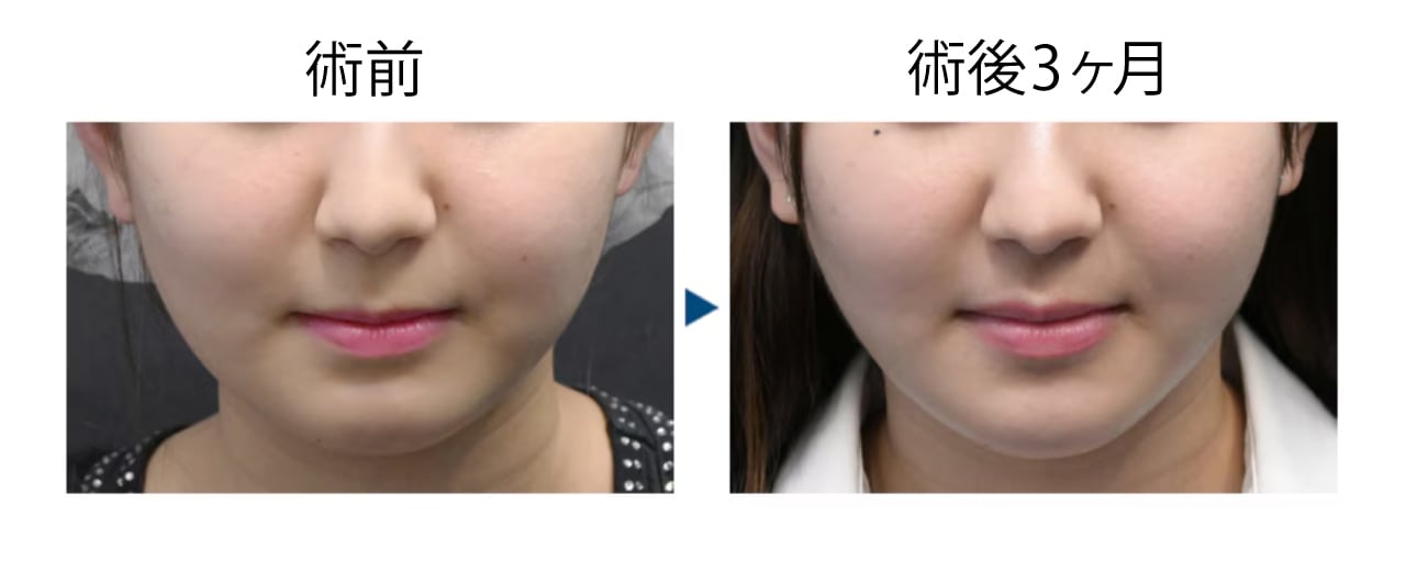 10代　脂肪吸引＋ジョールファット＋糸リフト
