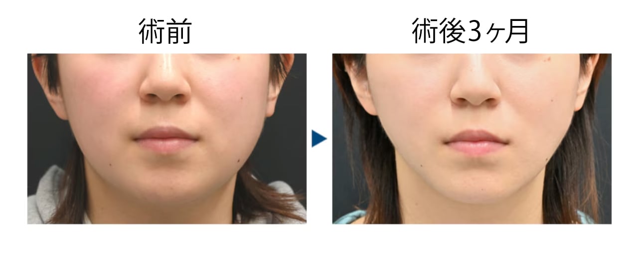 20代 脂肪吸引＋糸リフト