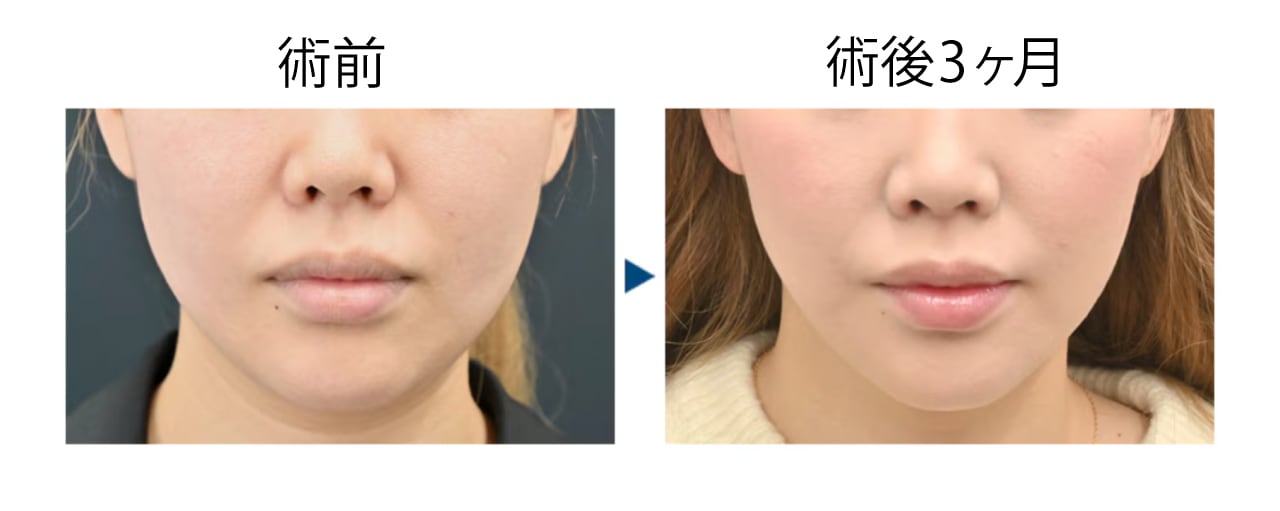 30代 脂肪吸引＋糸リフト