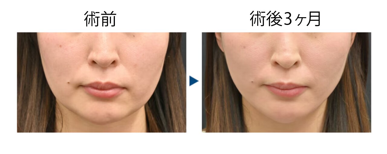 40代 脂肪吸引＋ジョールファット＋バッカルファット＋糸リフト
