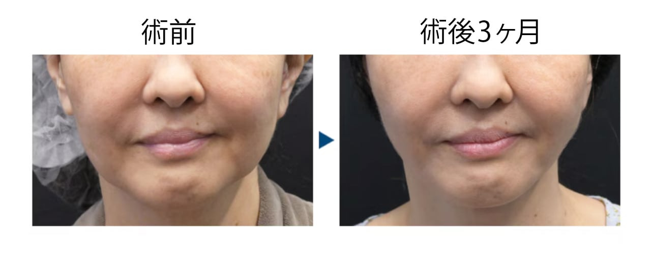 50代 脂肪吸引＋ジョールファット＋糸リフト