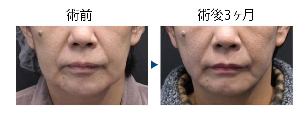 60代 脂肪吸引＋ジョールファット＋糸リフト
