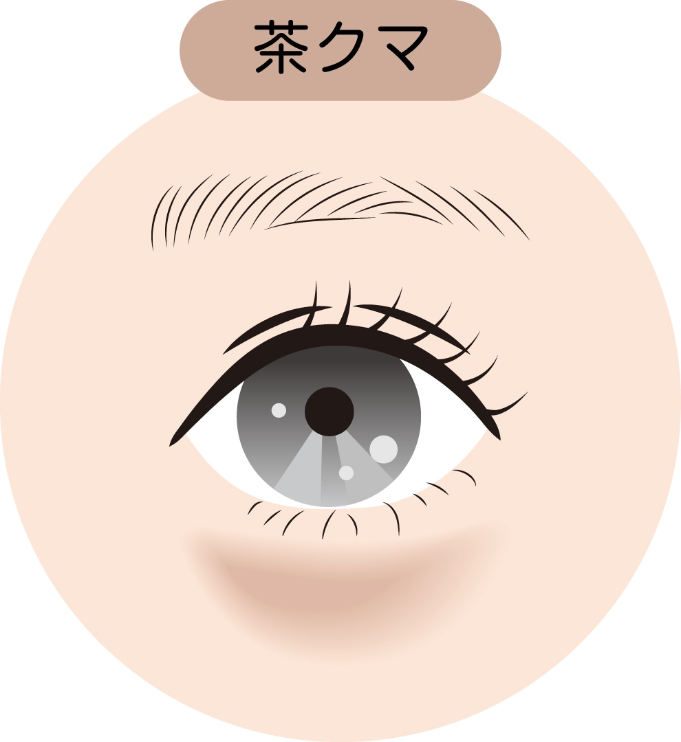 ②茶クマ(色素沈着)