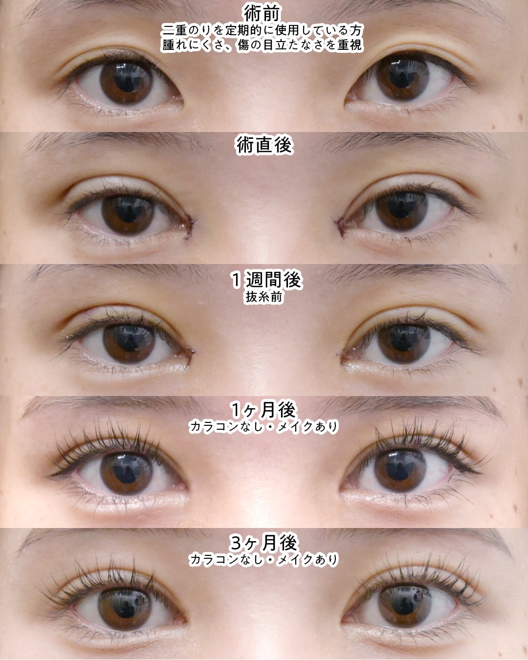 埋没二重×目頭切開