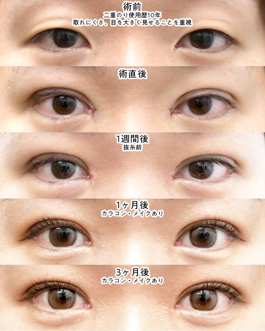 埋没二重×目頭切開