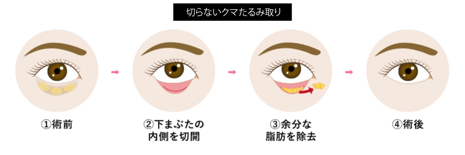 目の下の切らないクマ・たるみ取り