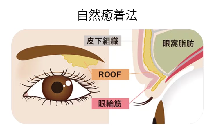 自然癒着法(自然癒着セット)