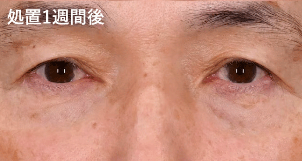 処置1週間後