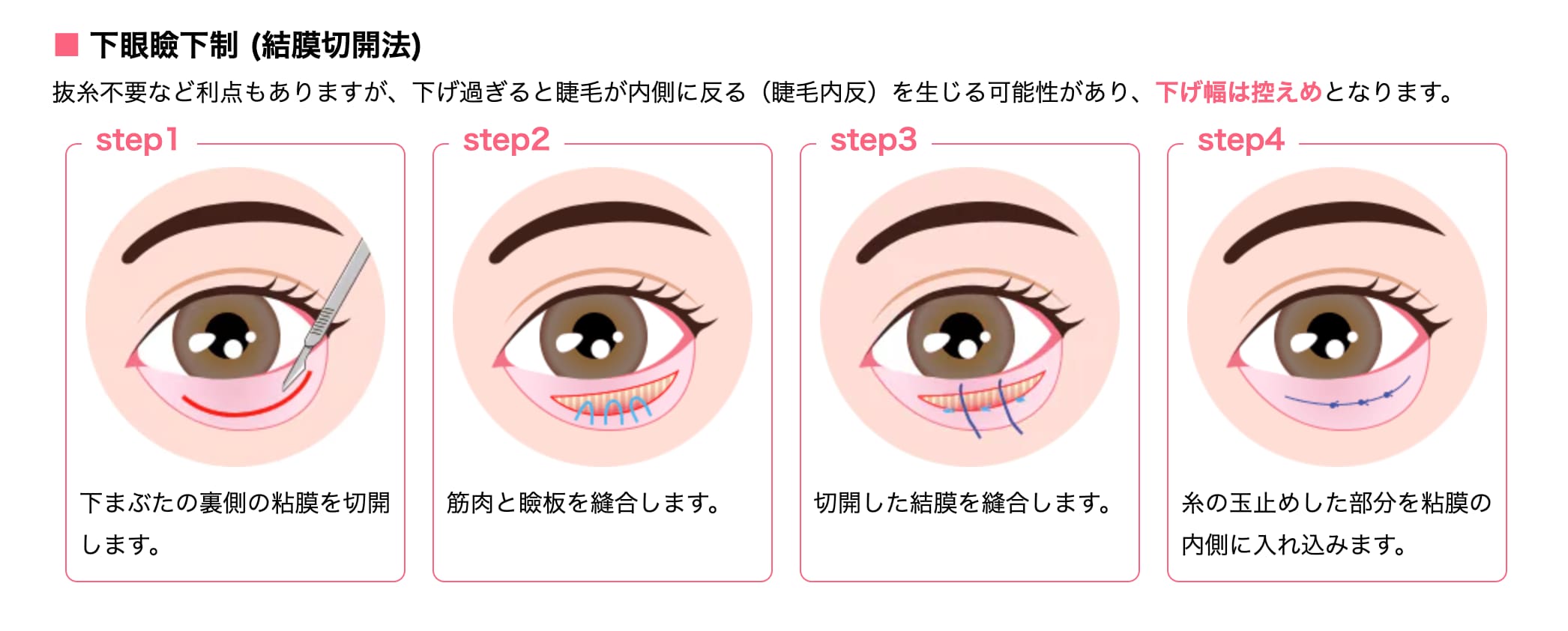 下眼瞼下制 (結膜切開法)(裏からの手術)